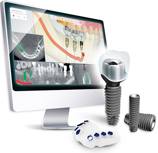 네비게이션 임플란트