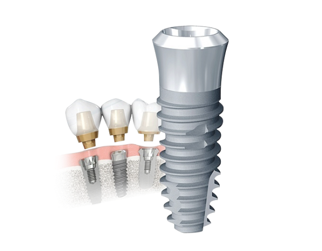 뼈이식 임플란트